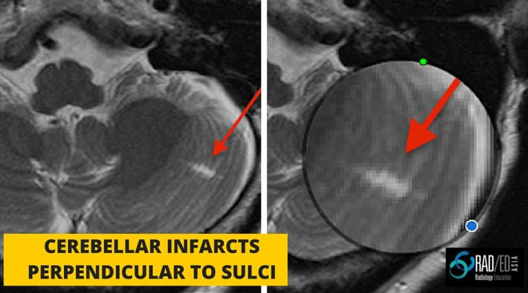 cerebellar-infarcts-chronic-mri