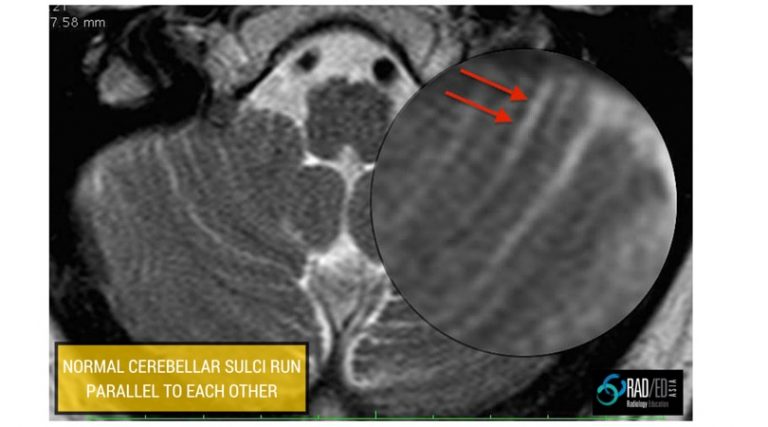 cerebellar-infarcts-normal-sulci-mri