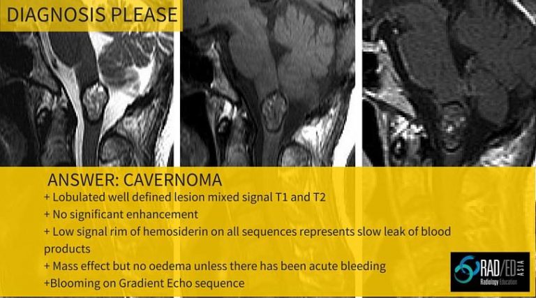 cavernoma-cord-mri-radiology-education-asia-radedasia