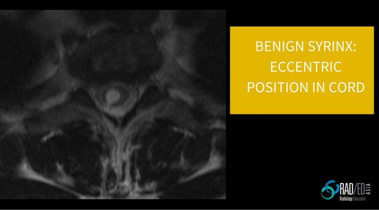 syrinx mri eccentric radedasia