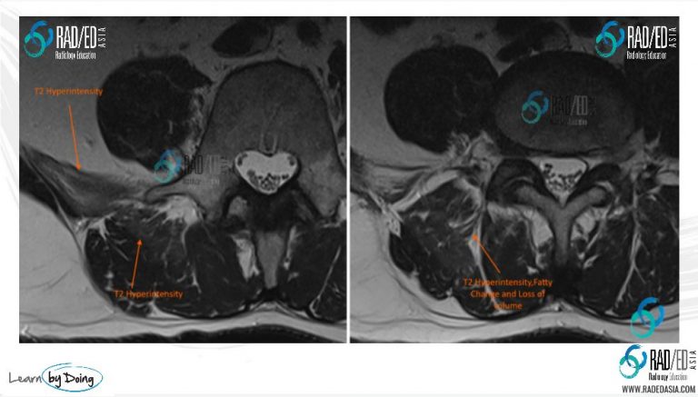 acute-denervation-mri-lumbar-paraspinal-radedasia-radedasia.