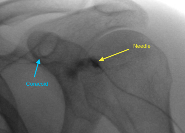 shoulder arthrogram mri mra radiology education asia