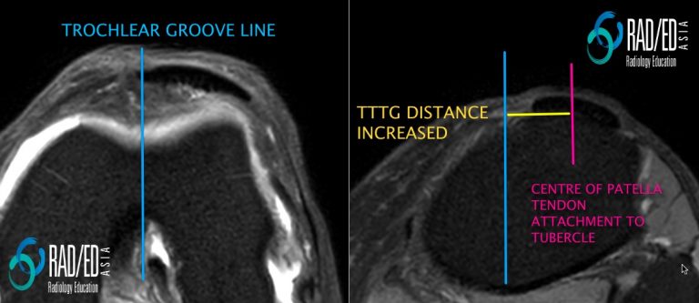 knee patella dislocation lateralisation of tubercle mri