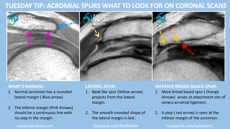 acromial spur mri radiology education asia radedasia