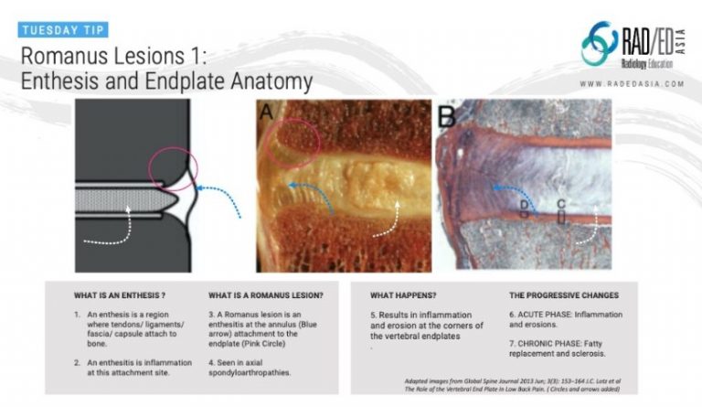 romanus lesion endplate anatomy mri enthesitis radedasia