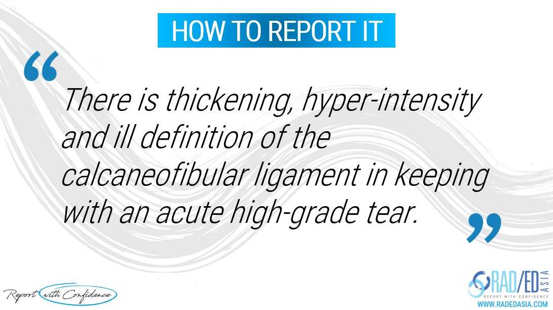 ankle mri ligaments cfl calcaneofibular report radedasia