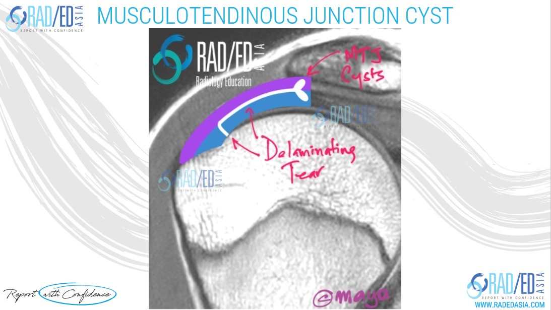 mri delaminating tear rotator cuff musculotendinoud junction cysts