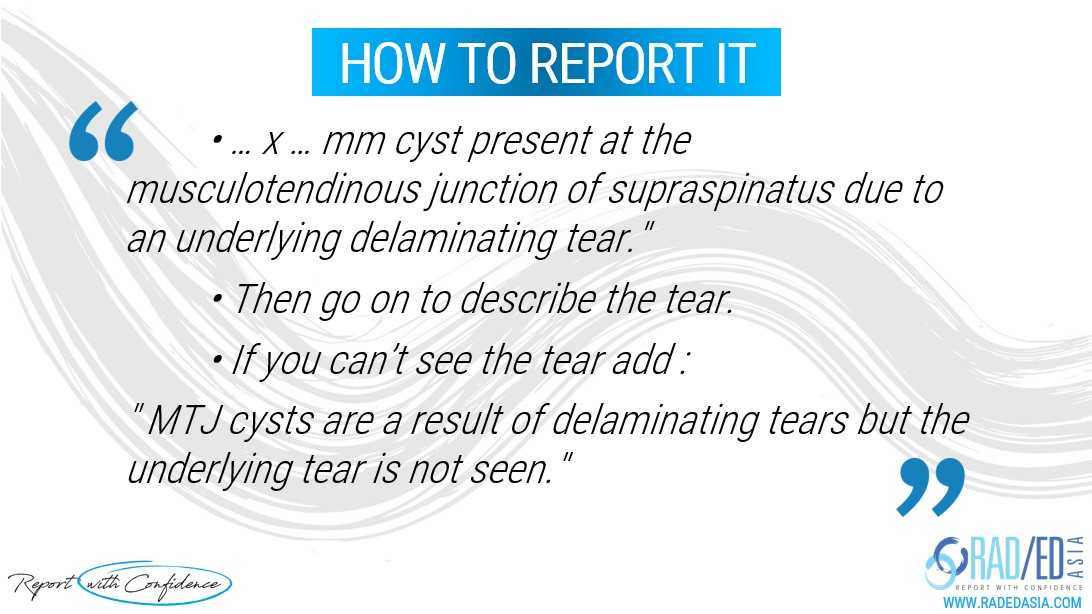 mri delaminating tear rotator cuff musculotendinous junction cyst report mri