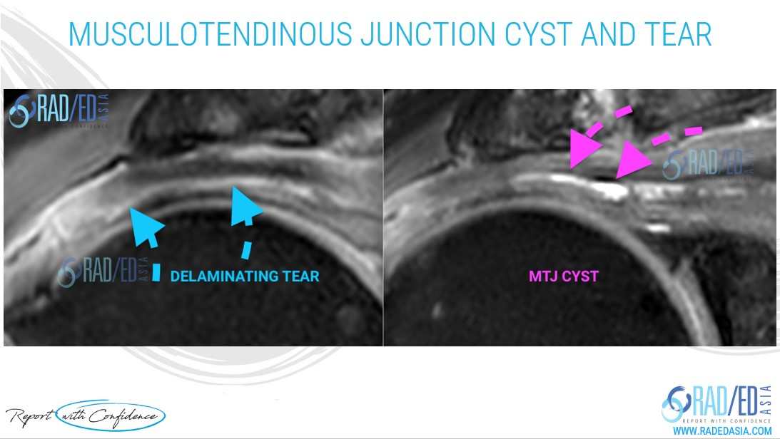 mri delaminating tear rotator cuff musculotendinous junction cyst