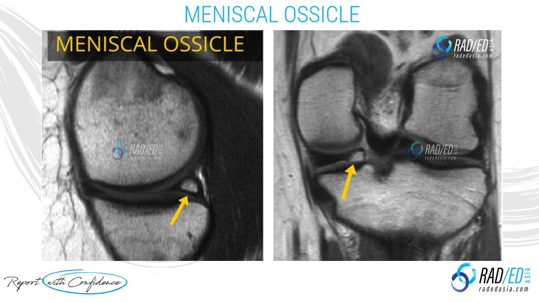 meniscal-ossicle-iso-intense-mri-radiology-radedasia