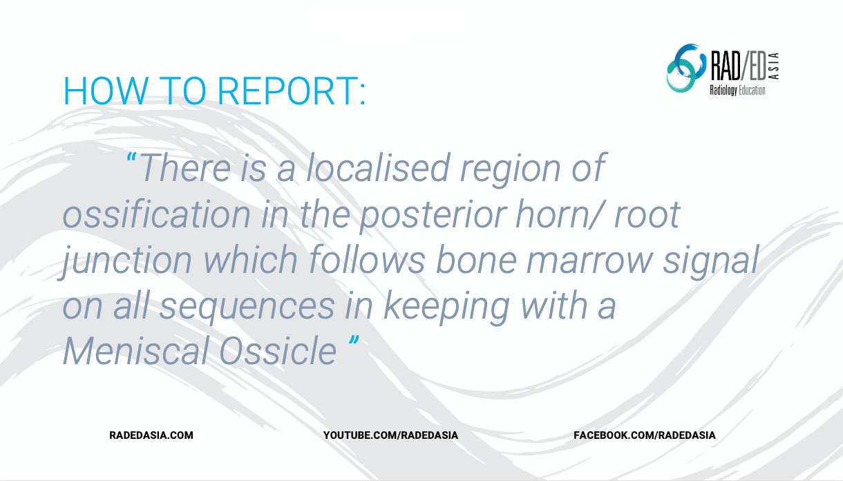 meniscal ossicle knee report mri radedasia