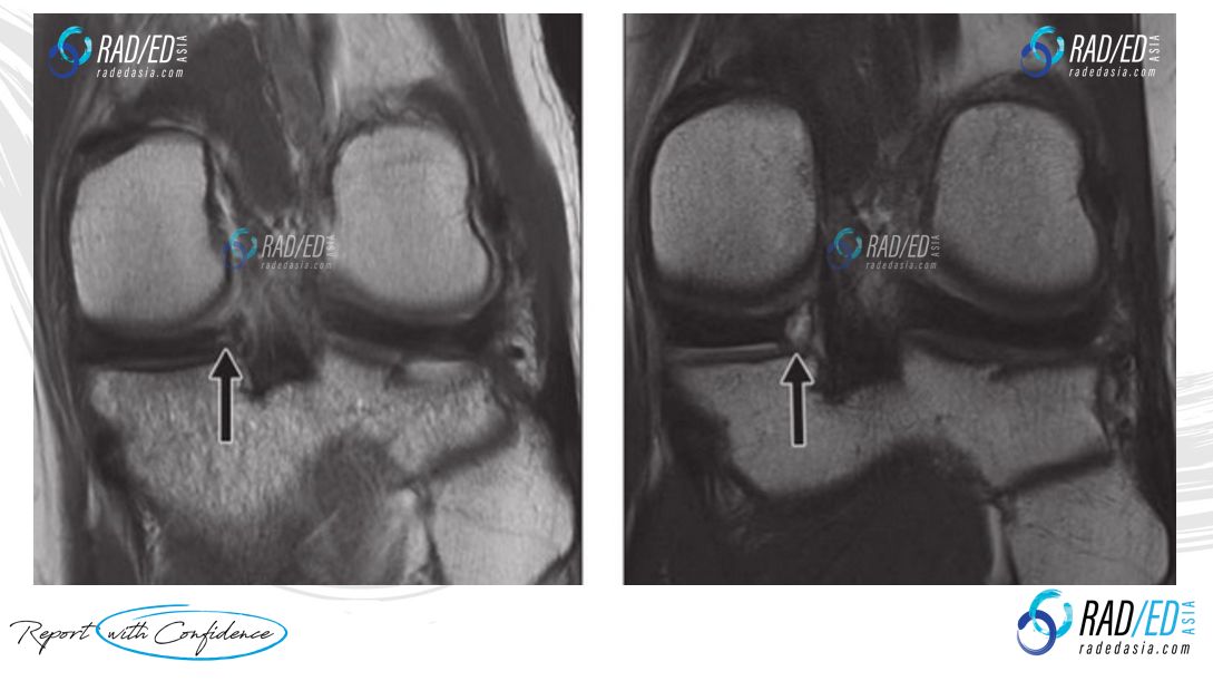 meniscal ossicle mri knee radedasia