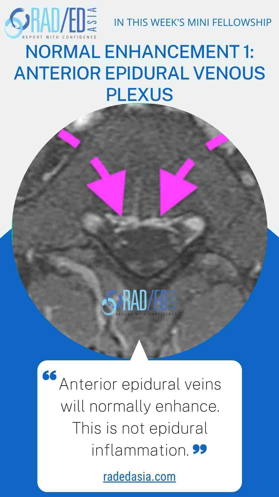 anterior epidural venous plexus enhancement radedasia