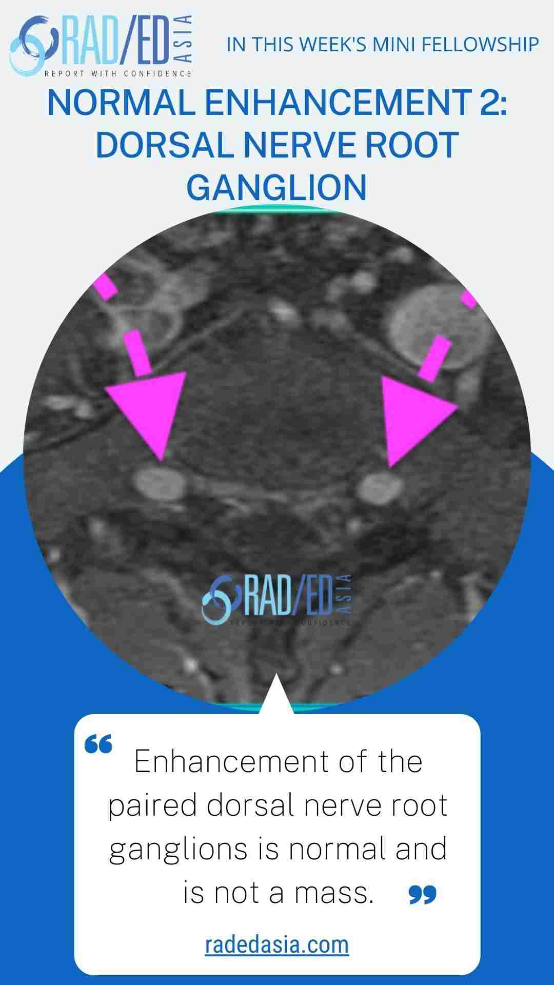 dorsal nerve root ganglion enhancement radedasia