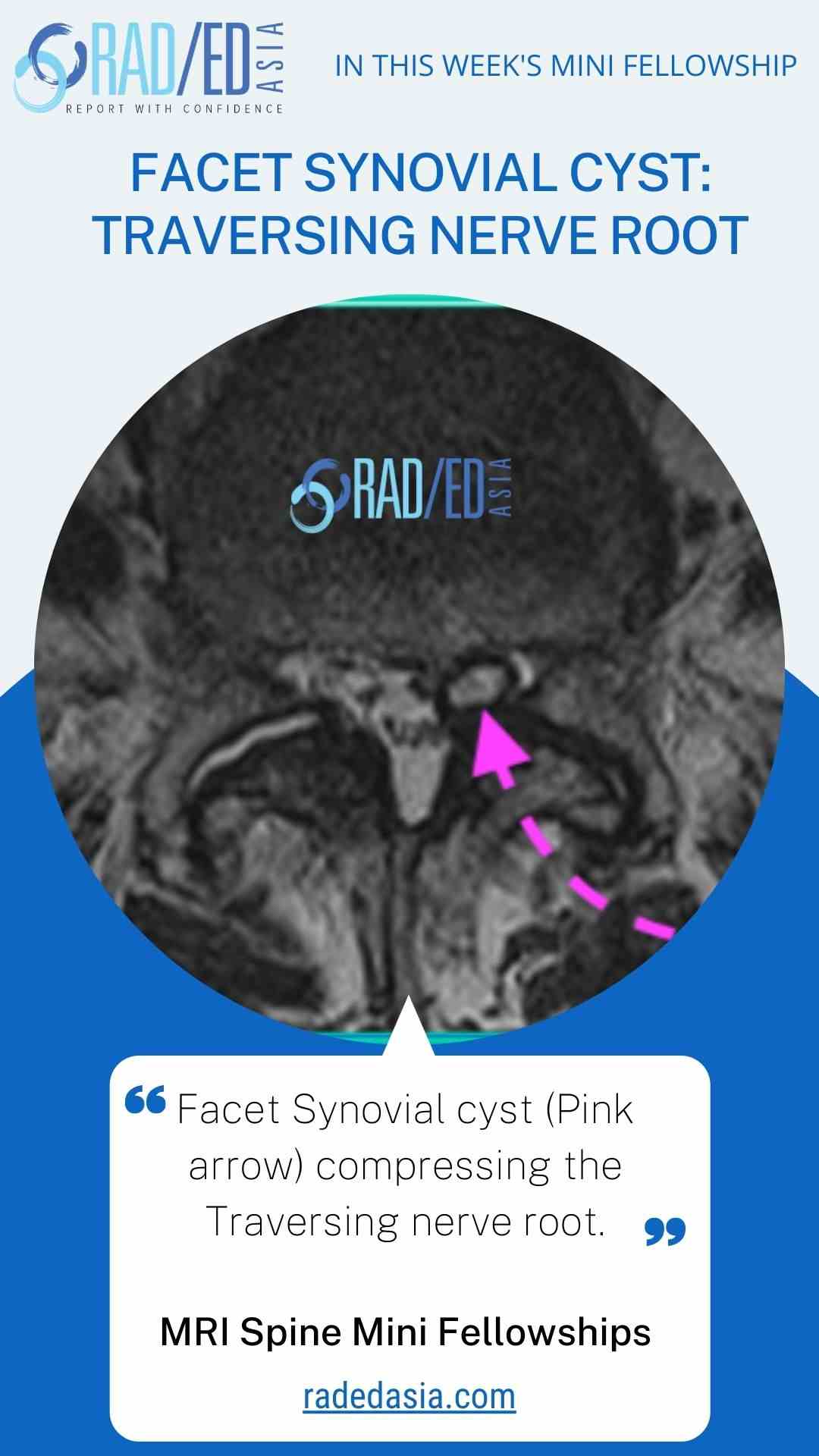 mri facet synovial cyst traversing nerve root radedasia