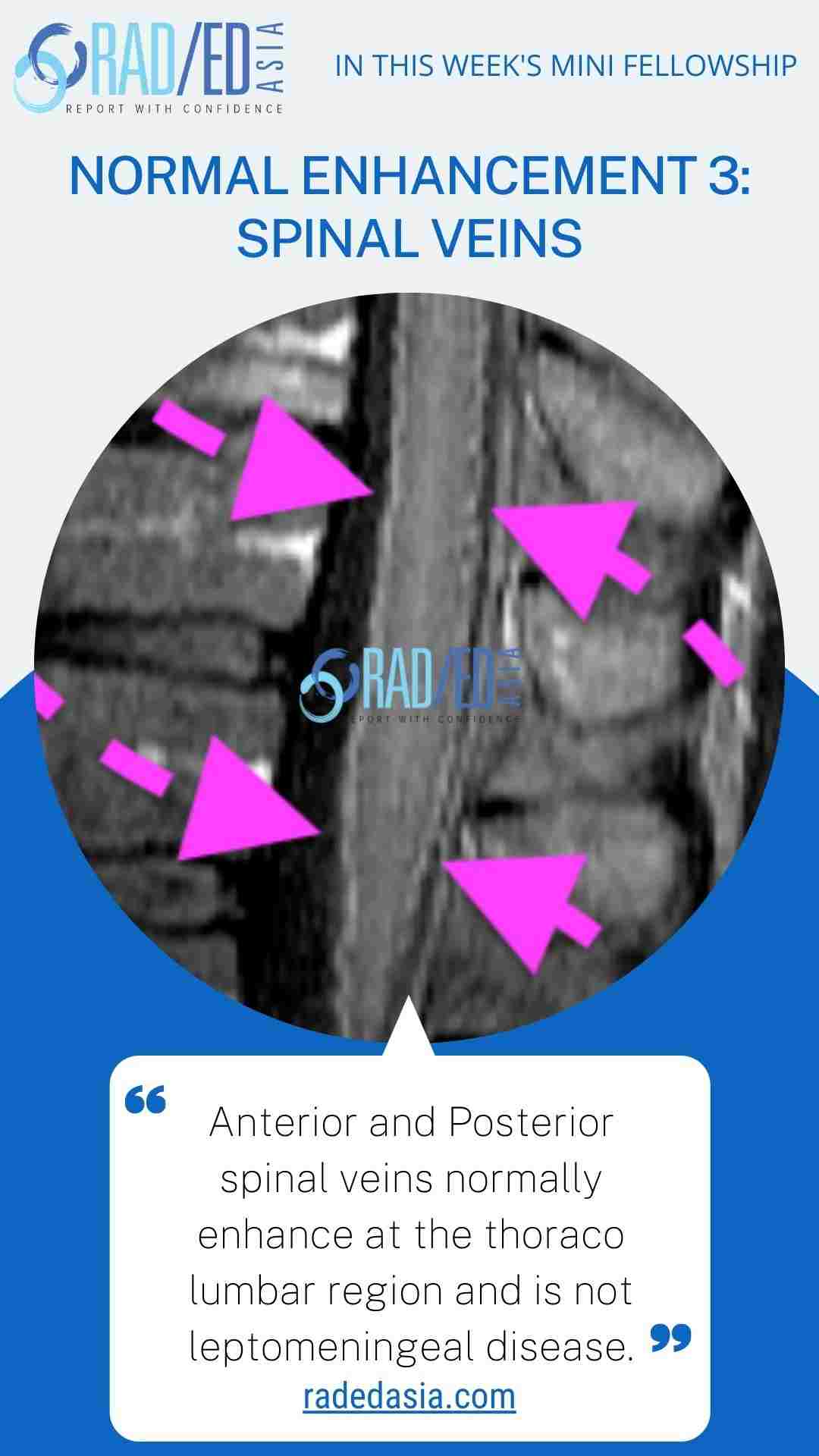 spinal veins enhancement radedasia