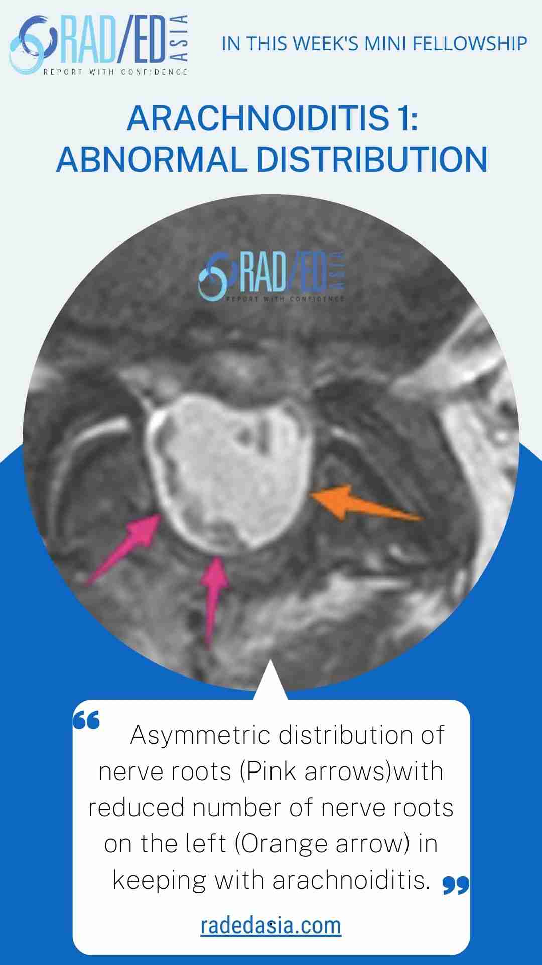 arachnoiditis abnormal distribution radedasia