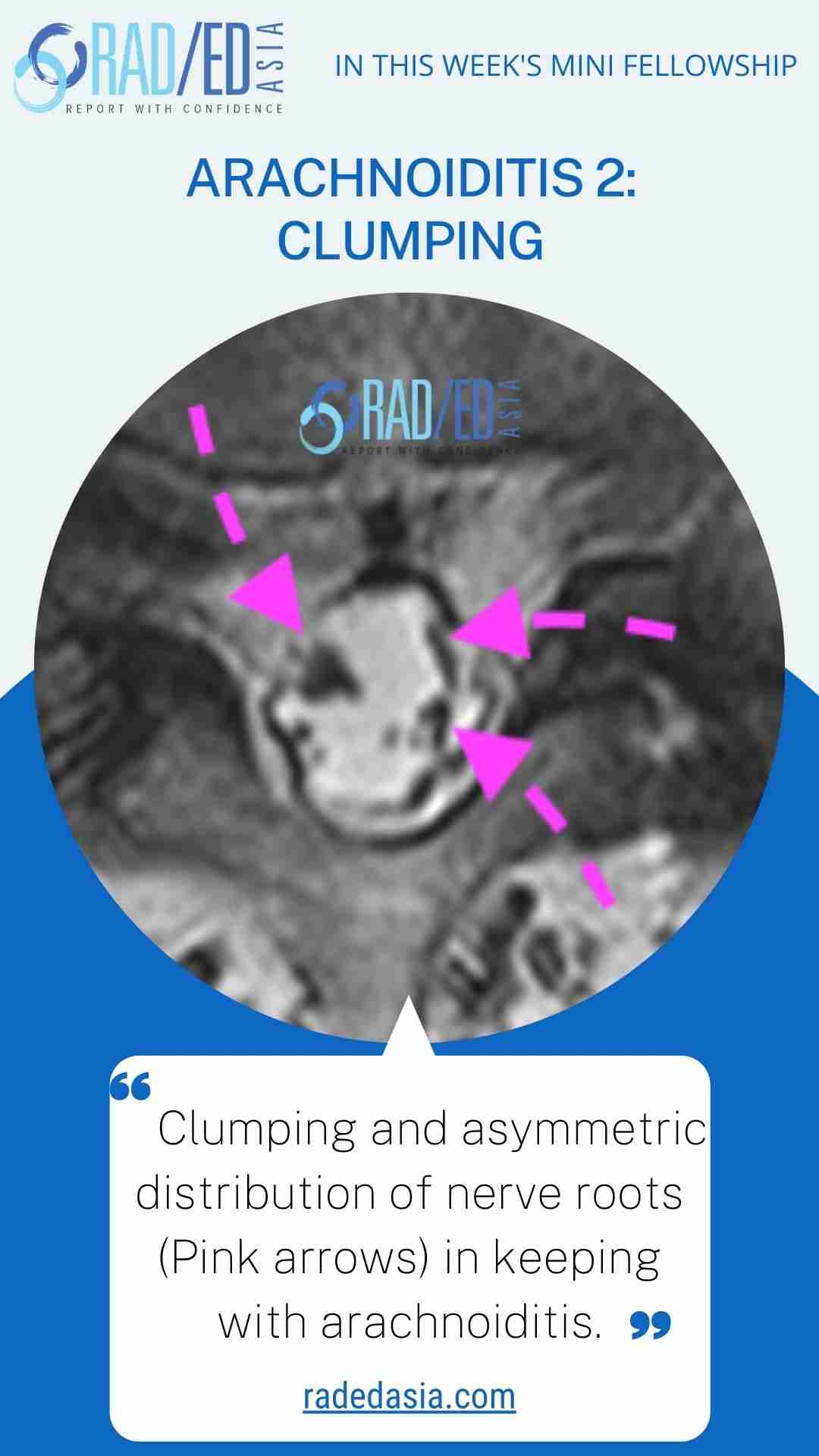 arachnoiditis clumping radedasia