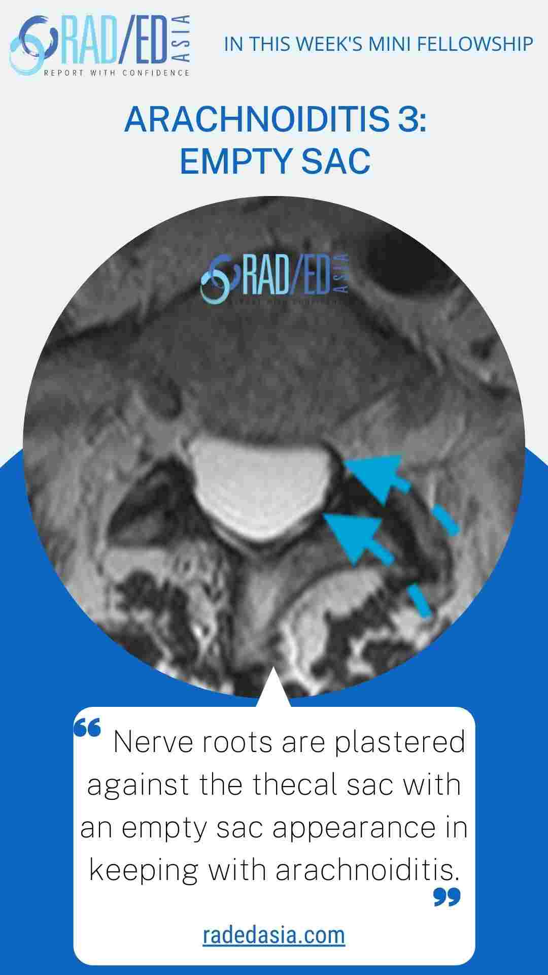 arachnoiditis empty sac spine mri radedasia