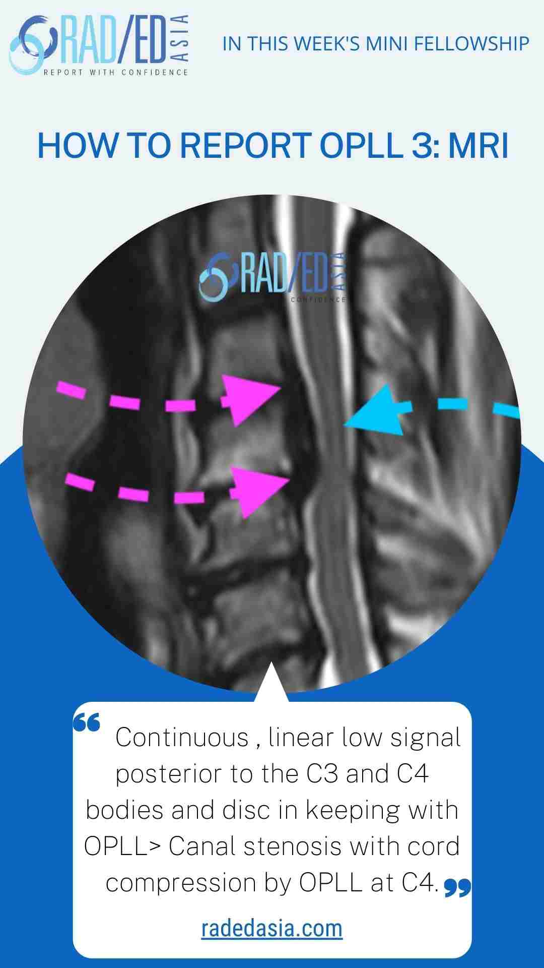 opll mri report spine radedasia