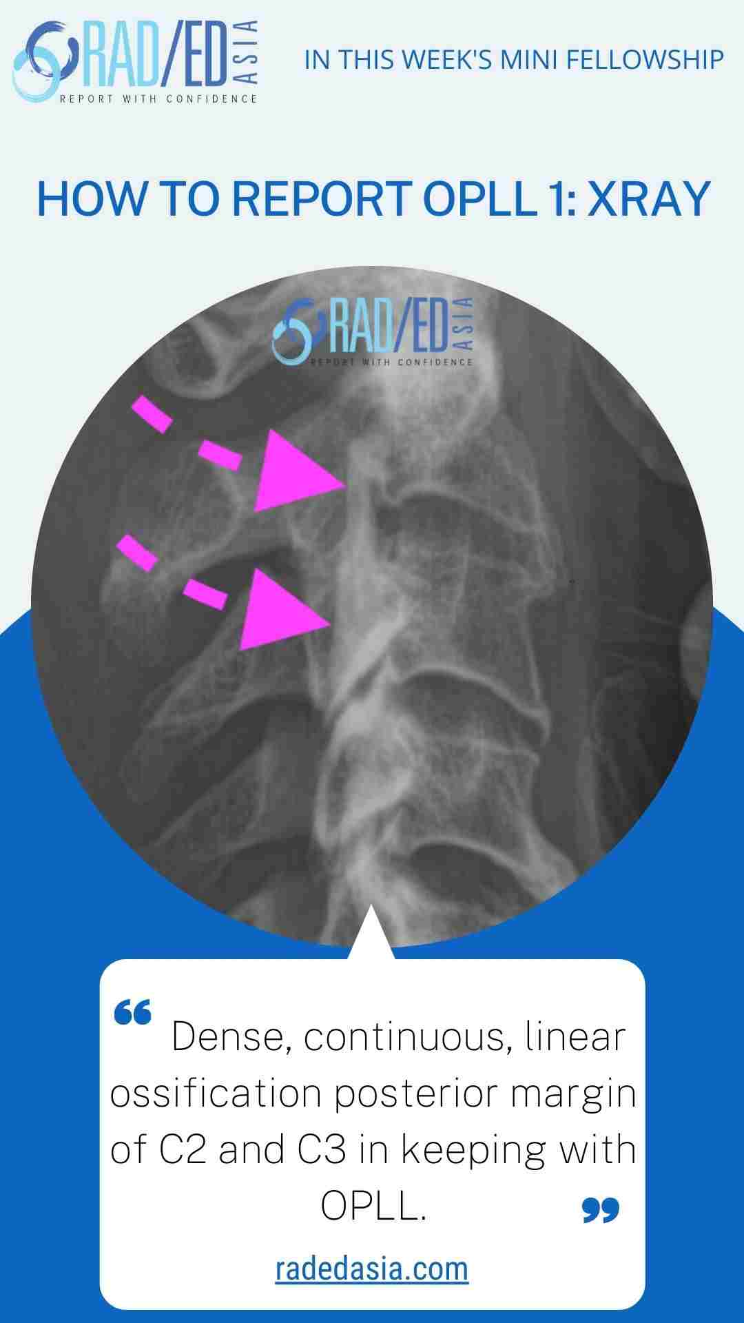 opll xray report spine radedasia