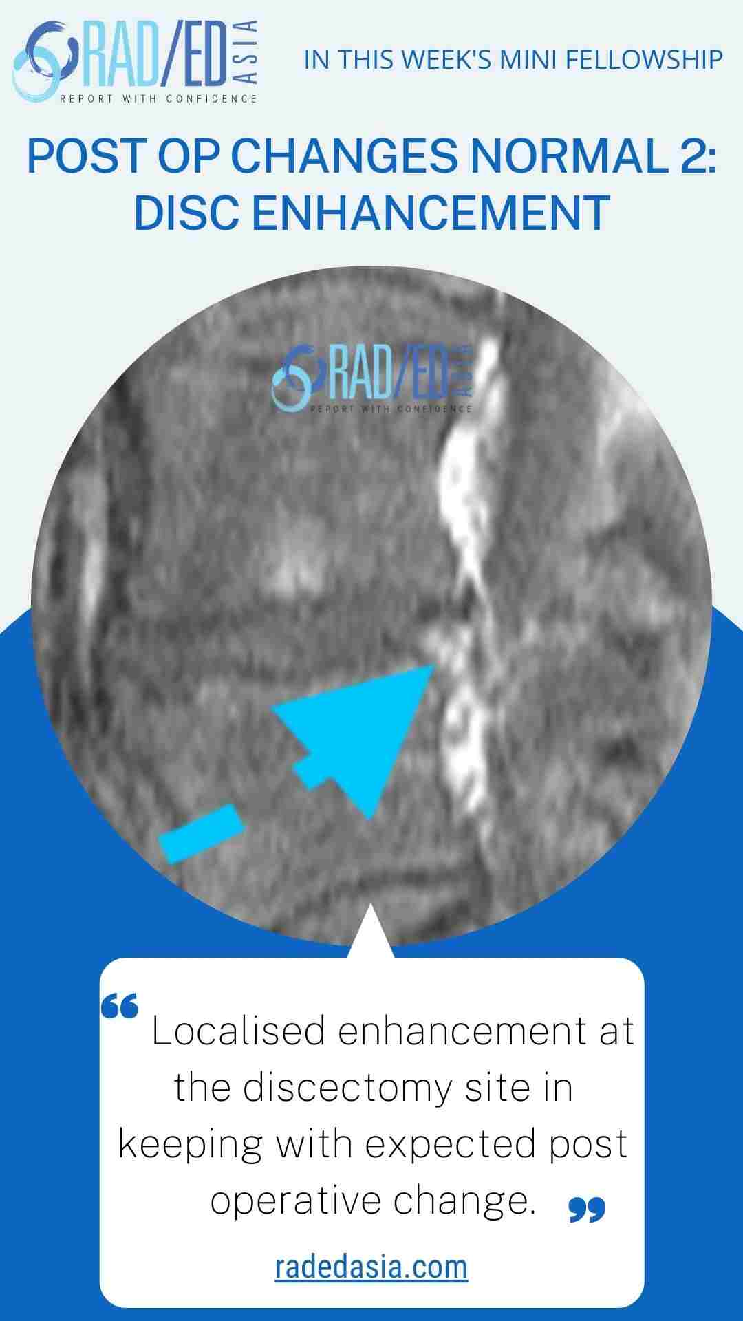 post op changes disc enhancement radedasia