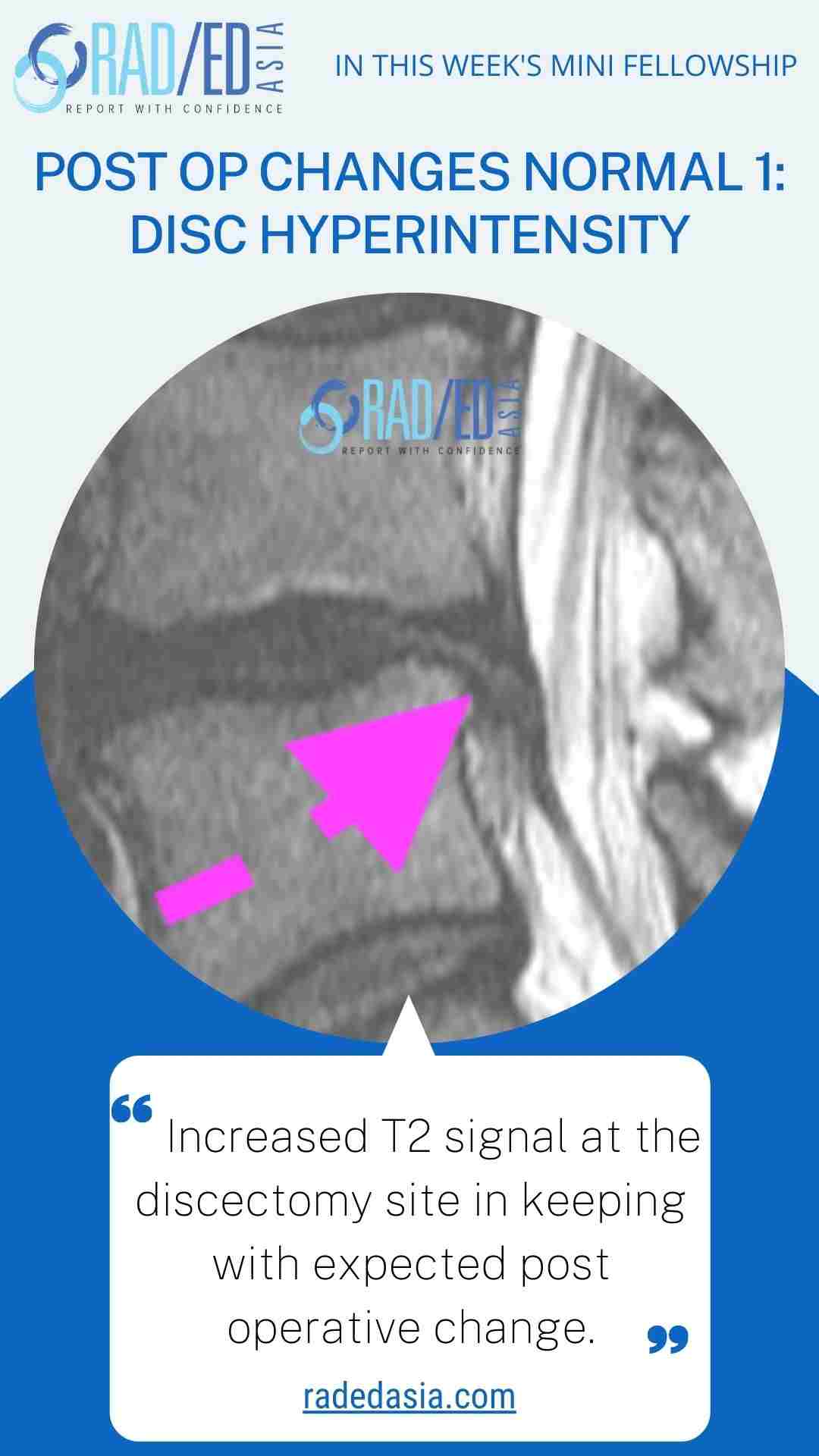 post op changes disc hyperintensity