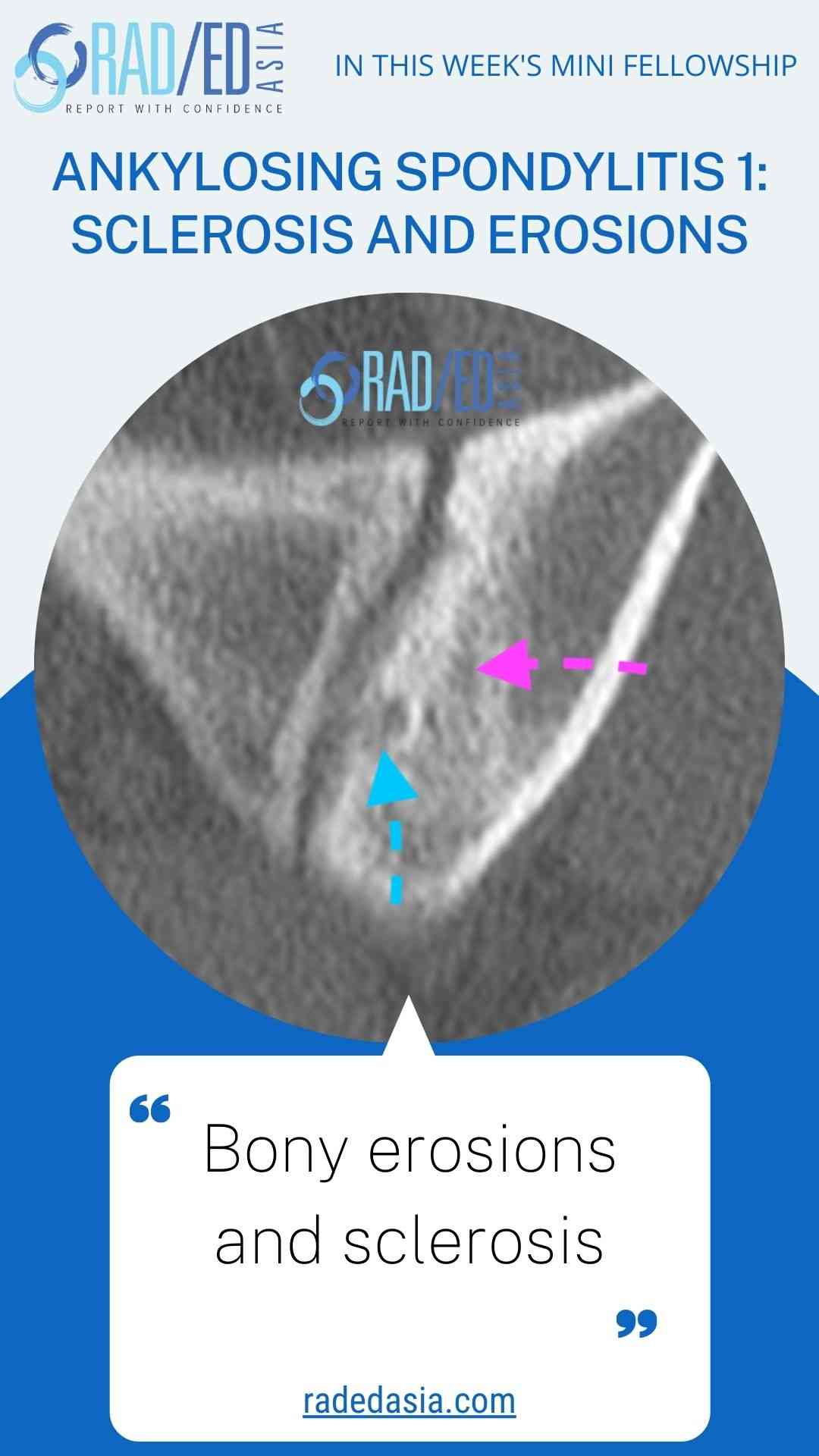 ankylosing spondylitis 1 scelrosis & erosions radedasia