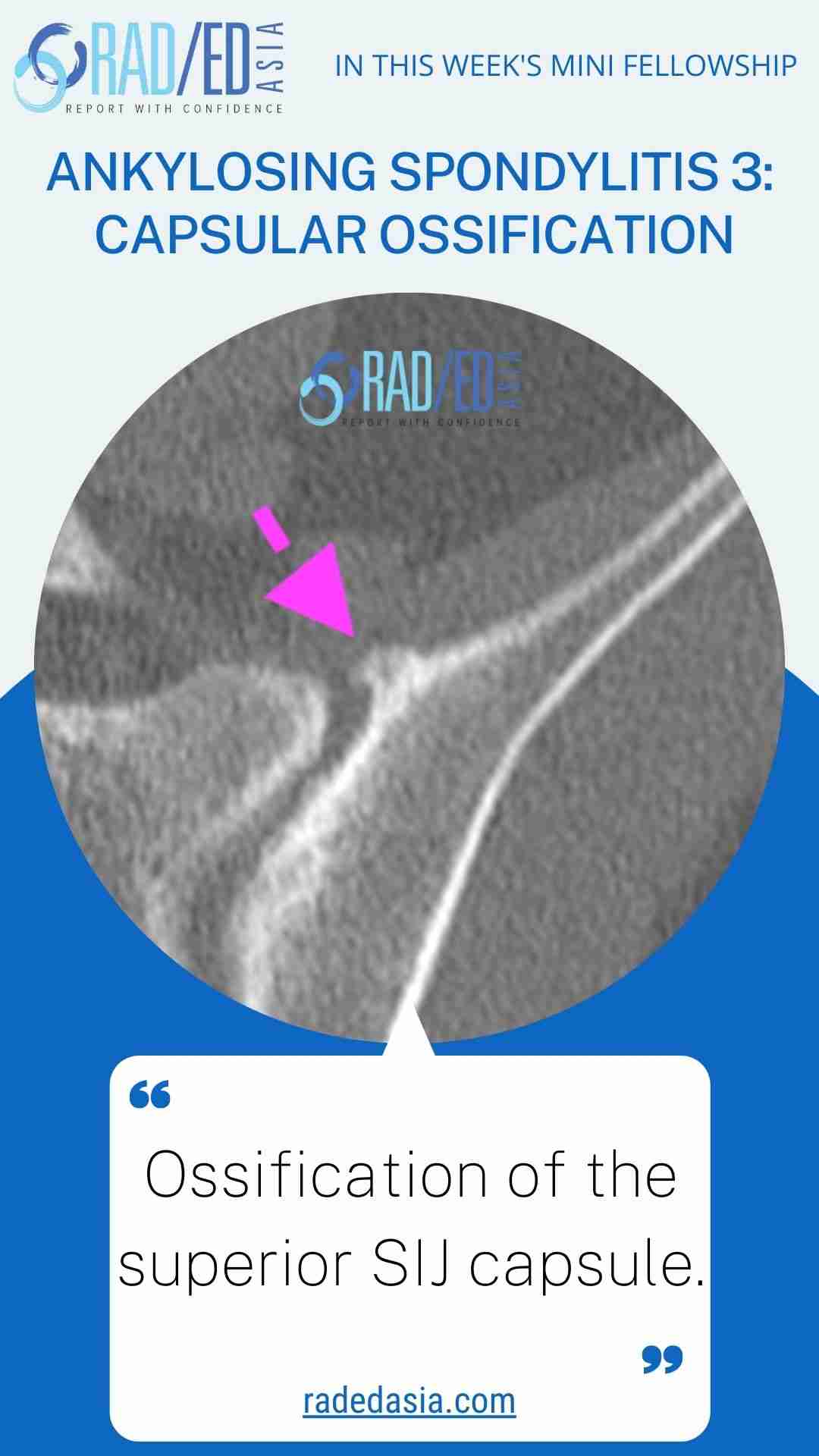 ankylosing spondylitis 3 capsular ossification radedasia