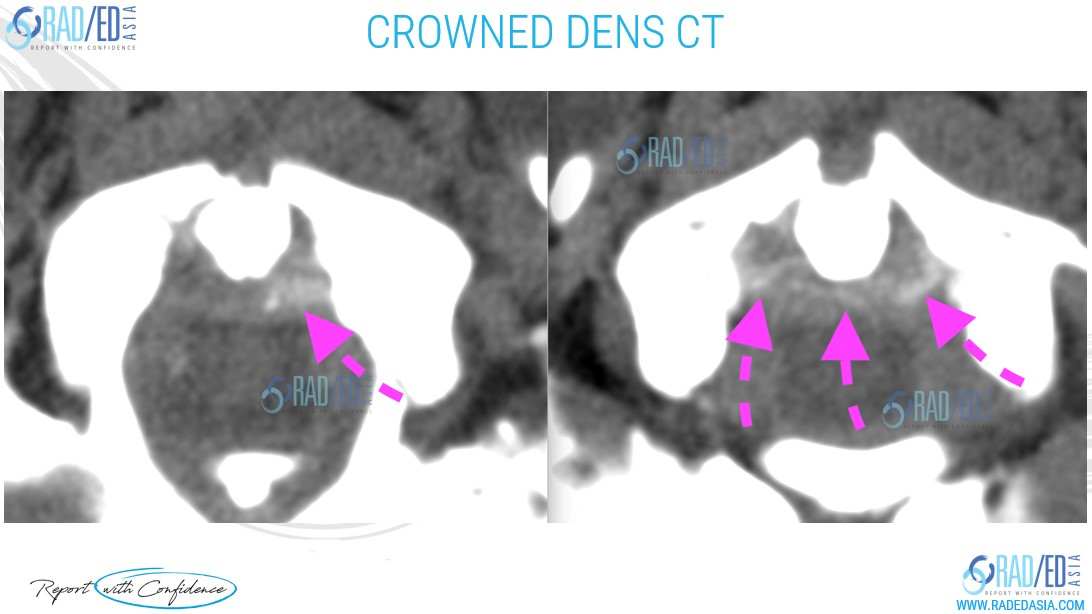 cppd crowned dens ct spine online radiology courses radedasia