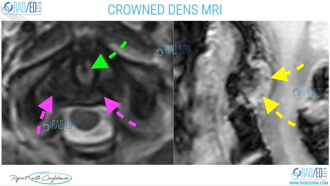 cppd crowned dens mri spine online radiology courses radedasia