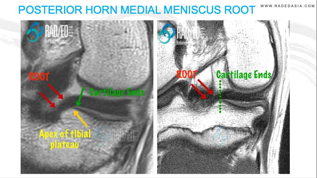 mri knee meniscus root post horn medial anatomy radedasia