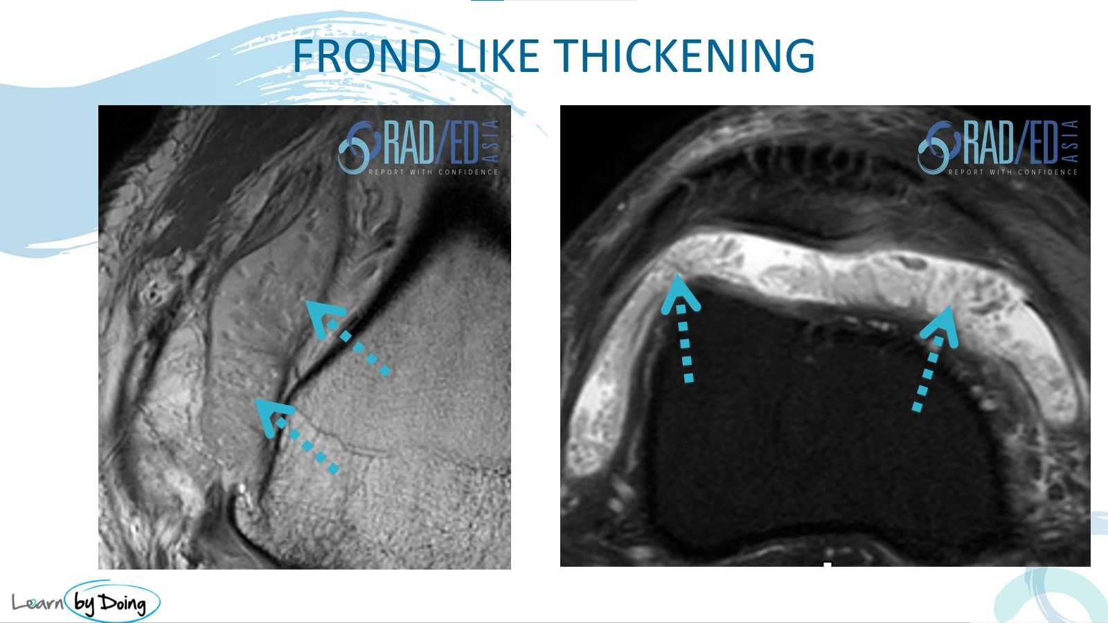 mri synovitis knee frond like radedasia