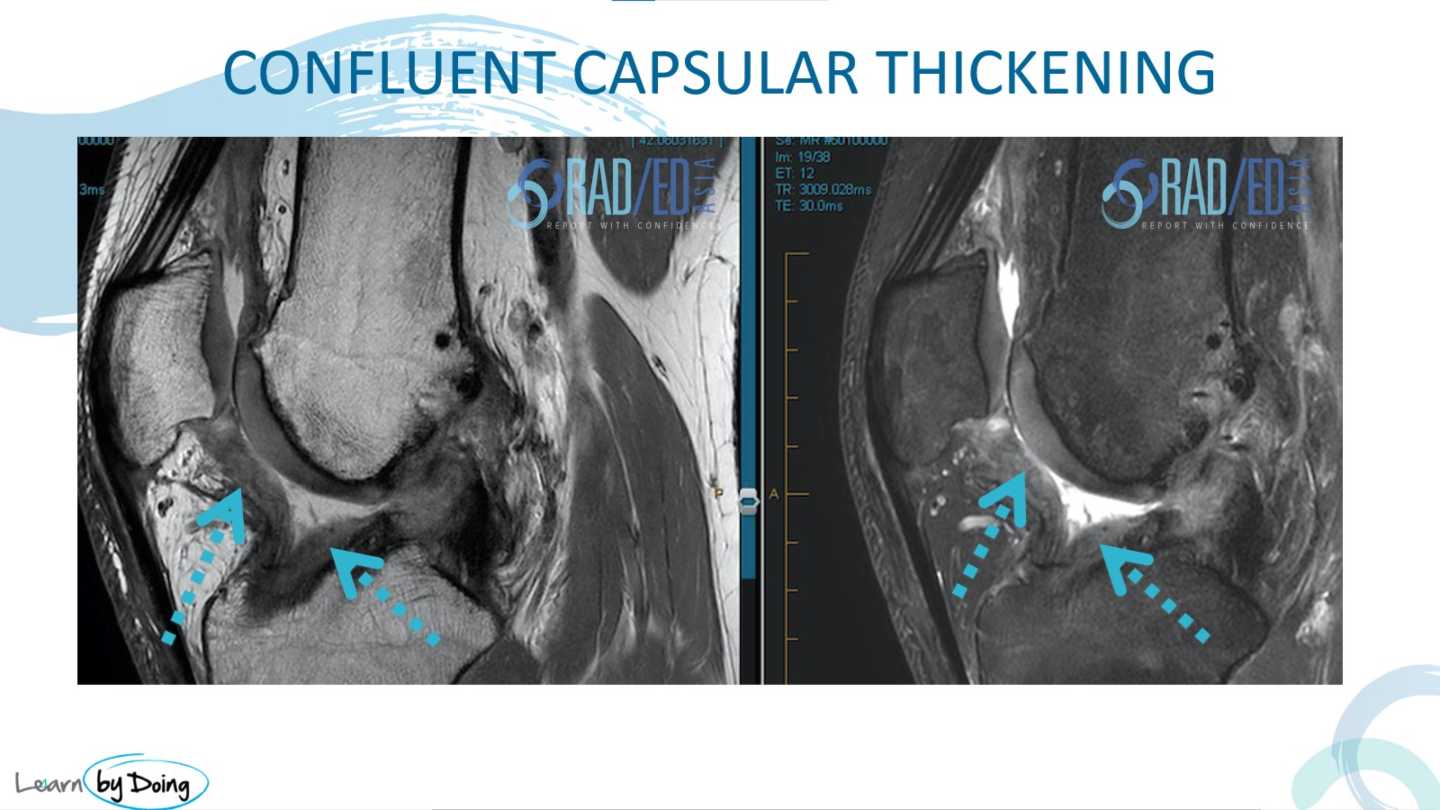 mri synovitis knee thickening capsular radedasia