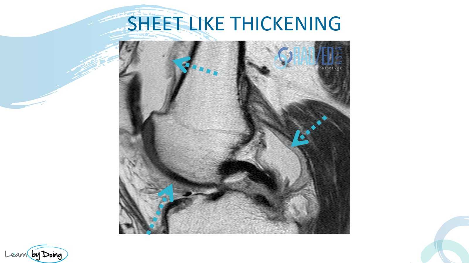 mri synovitis knee thickening sheet like radedasia