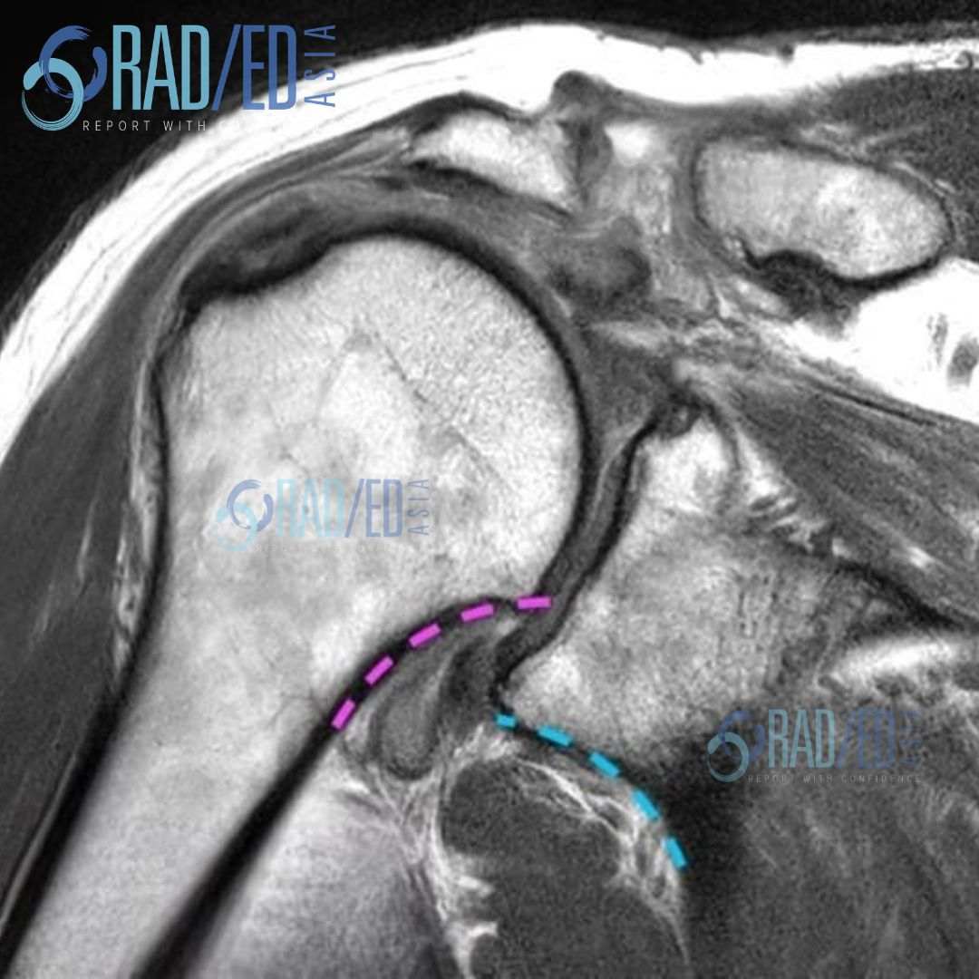 glenohumeral joint humeral subluxation humerus scapulohumeral moloney's line gothic arch mri xray radiology radedasia rea