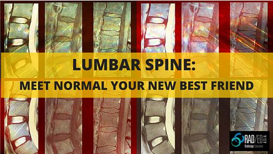 lumbar-mri-normal-radedasia