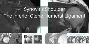 synovitis mri ighl shoulder