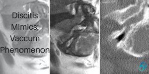 discitis mimics vacuum phenomenon radiology education asia radedasia