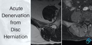 denervation lumbar mri paraspinal