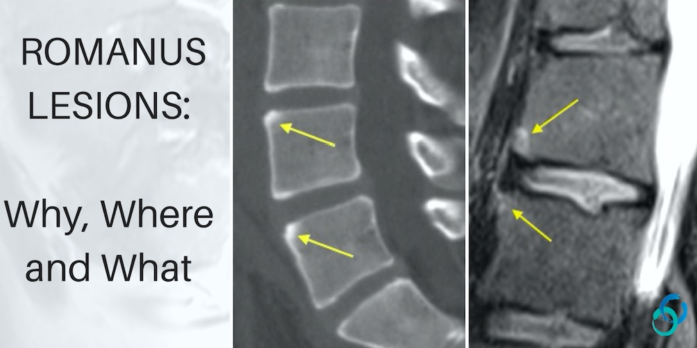 romanus lesion spine