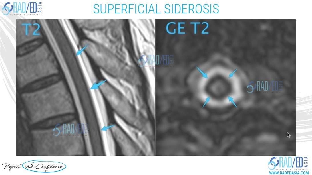 superficial siderosis mri cord nerve root spine radedasia