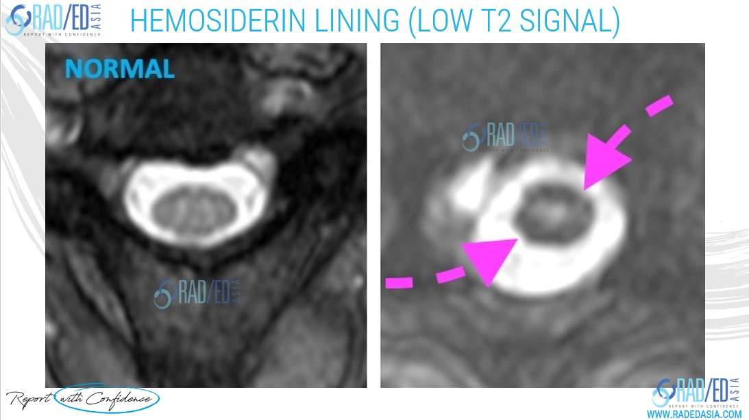 superficial siderosis mri spine cord nerve root radedasia