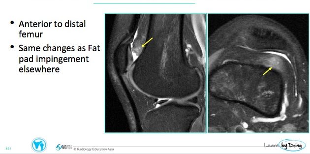 mri knee fat pad impingement suprapatellar impingement radiology education asia