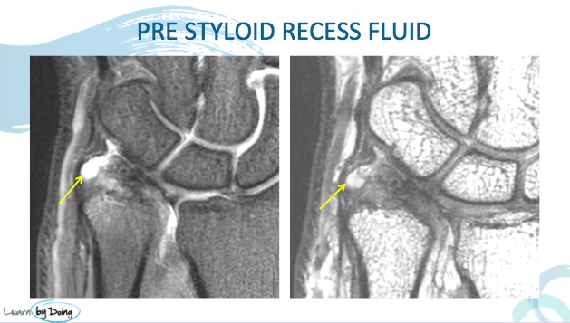 tfcc wrist mri radiology education asia