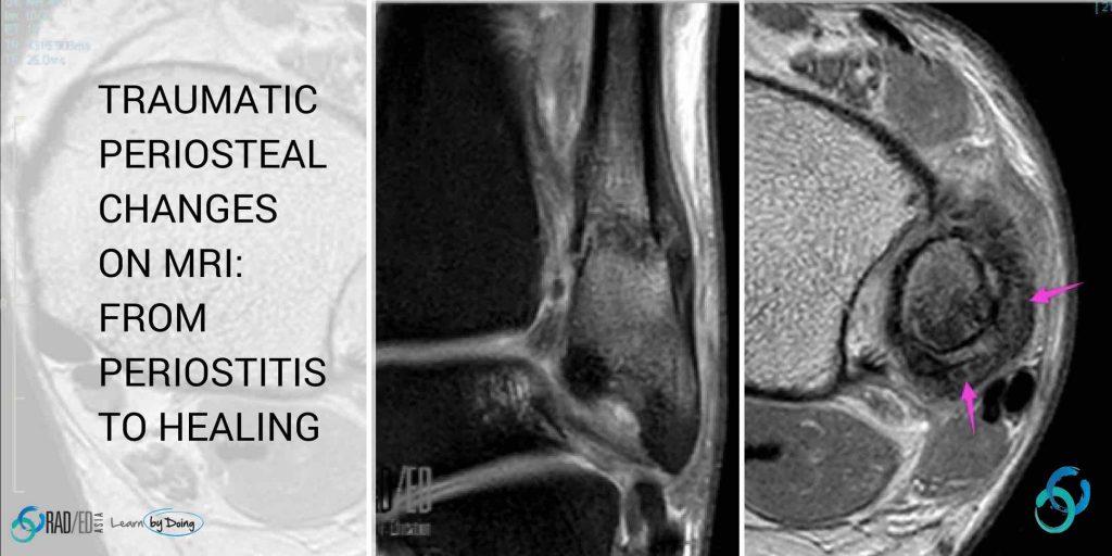 mri periosteum callus periosteal new bone radedasia radiology education