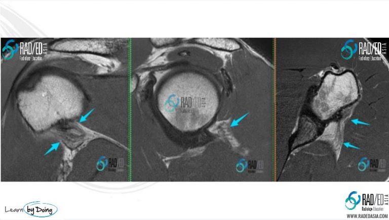 quadrilateral-space-syndrome-teres-minor-atrophy-radiology-education-asia-radedasia(1)