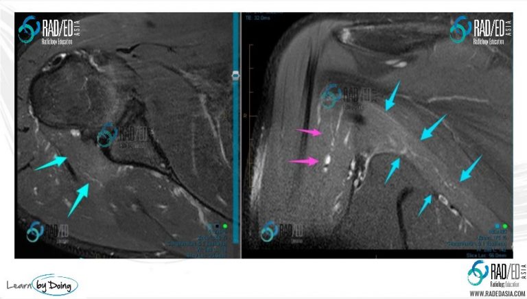 shoulder-dislocation-mri-axillary-nerve-denervation-post-dislocation-radiology-education-asia-radeda