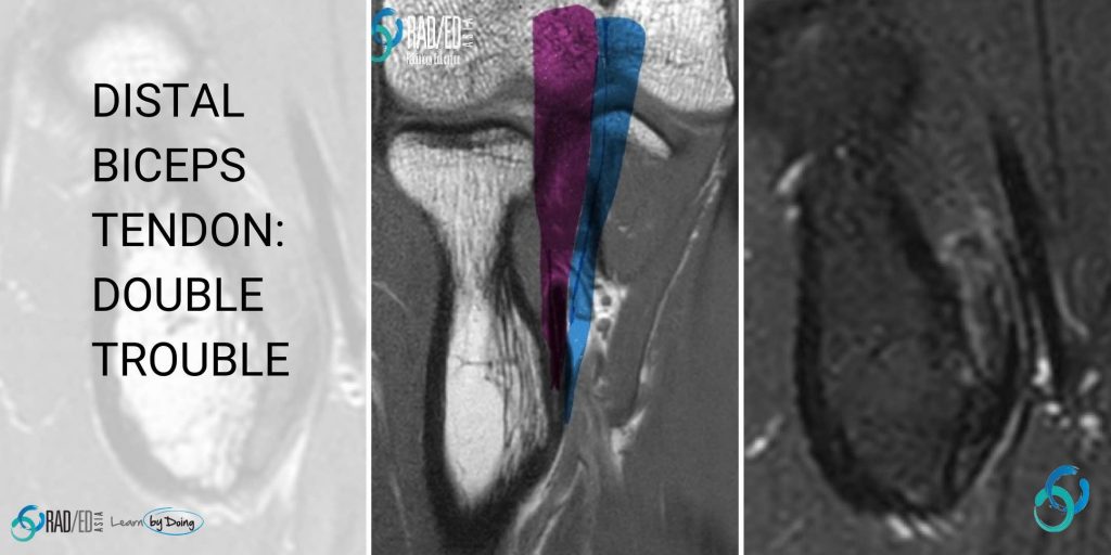 biceps tendon mri tear tendonosis rupture radiology education asia