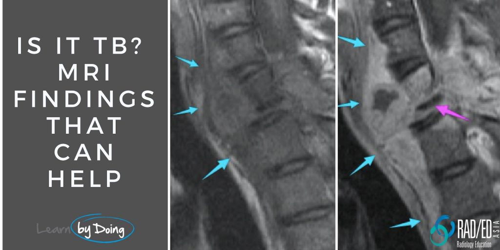 tb spine tuberculosis mri radiology education asia